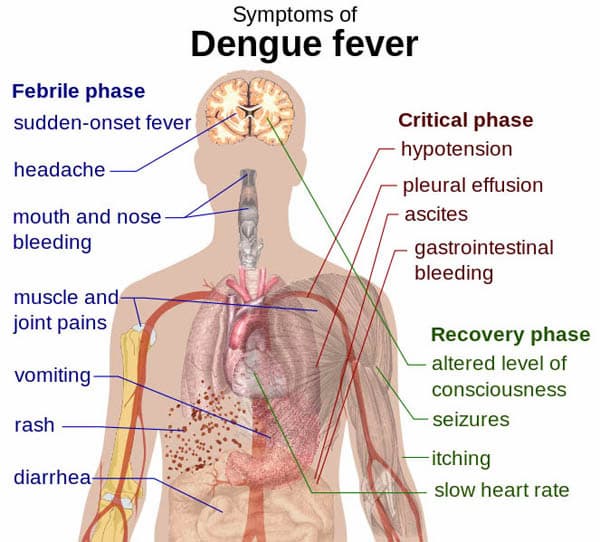 Dengue fever entails many severe symptoms